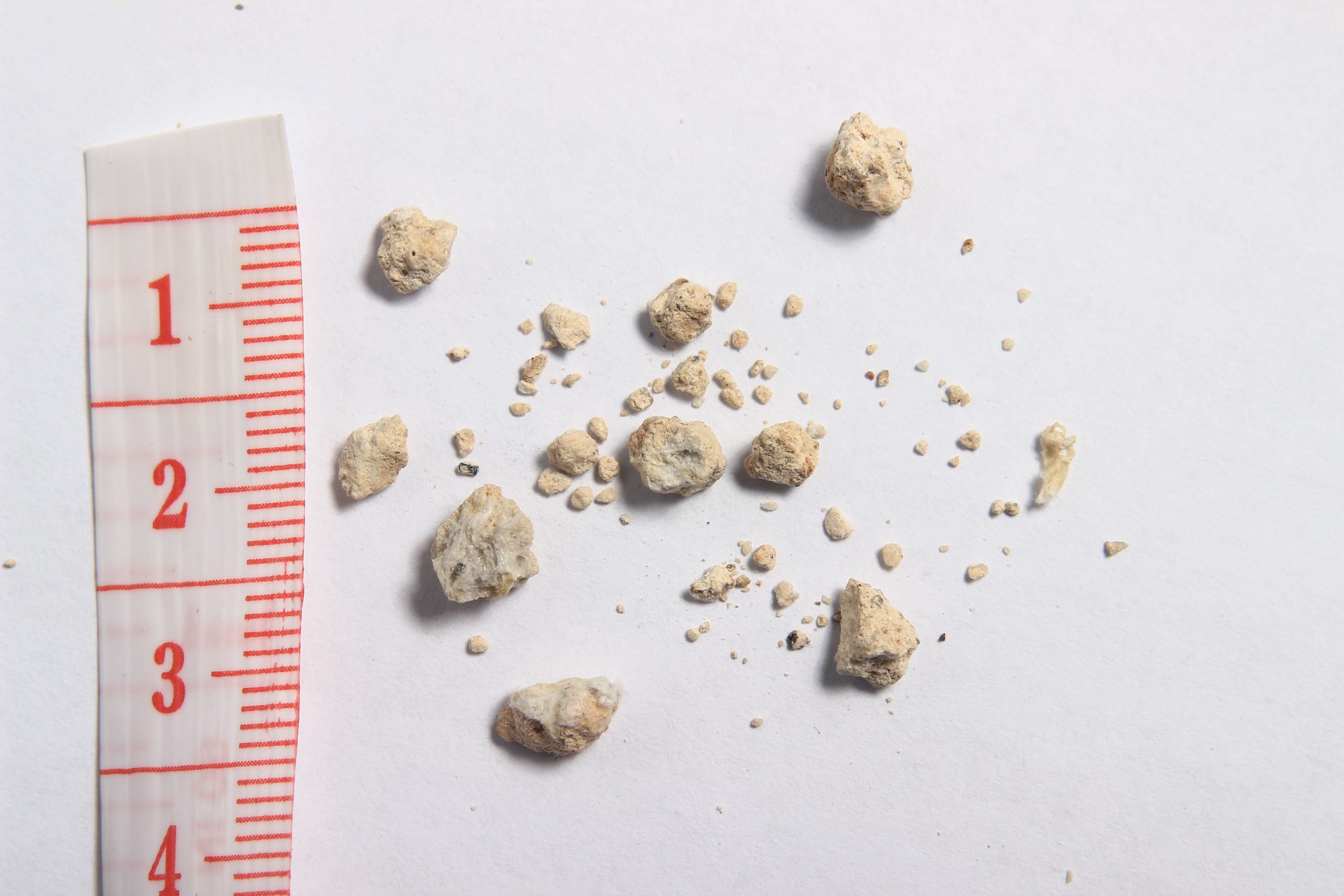 Small Kidney Stones
