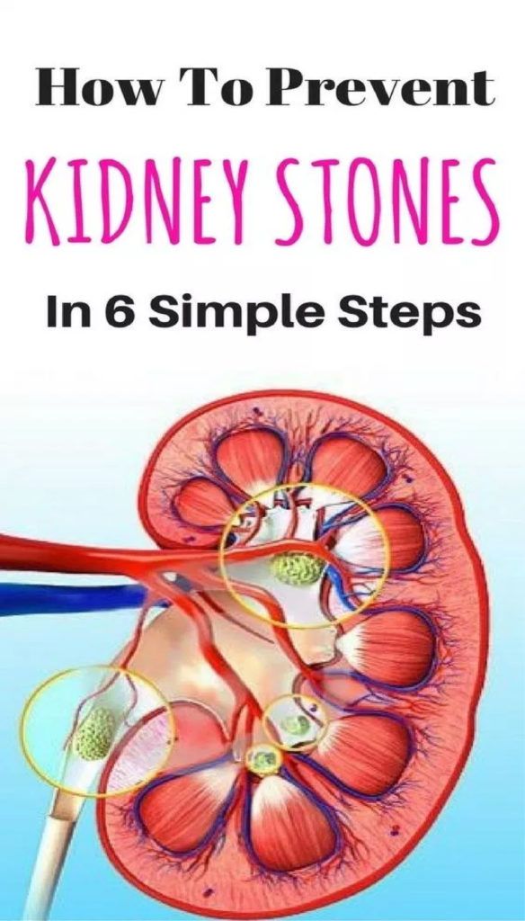 Small kidney stones may go undetected as they dont cause ...