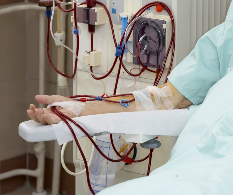 Stage 5 Kidney Failure Life Expectancy with Dialysis