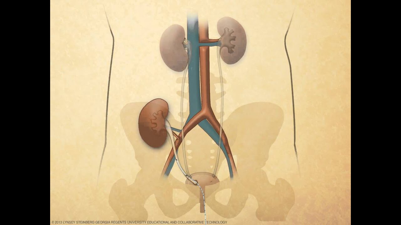 Stent Removal from Kidney Transplant