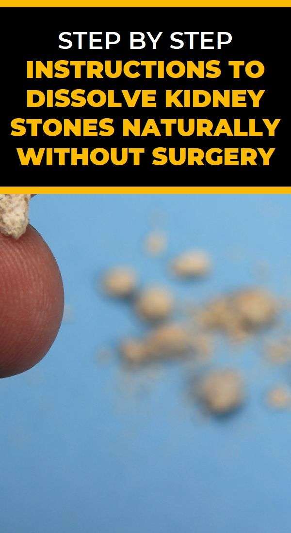 Step By Step Instructions To Dissolve Kidney Stones Naturally Without ...