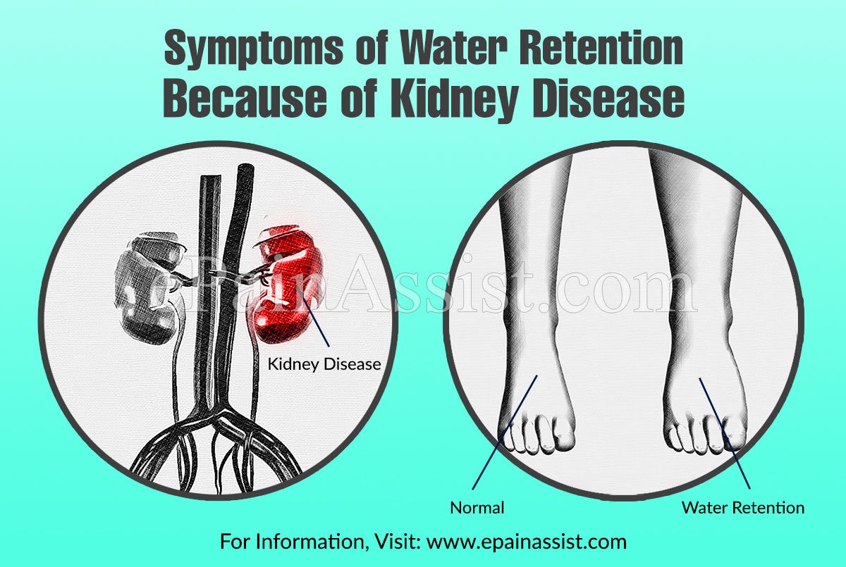 does-kidney-disease-cause-water-retention-healthykidneyclub