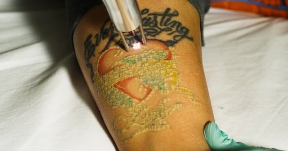 Tattoo removal pensacola fl cost