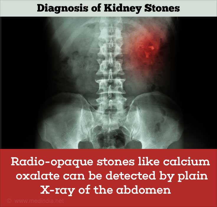 Tests for Kidney Stones