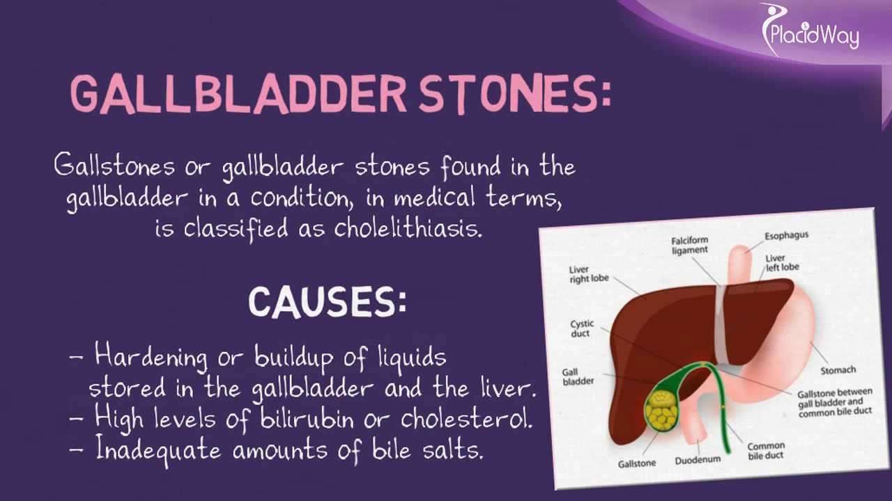 The difference: Best Gallstones Surgery and Best Kidney Stones Surgery ...
