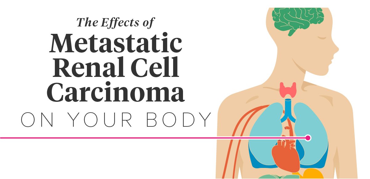 The Effects of Metastatic Renal Cell Carcinoma on the Body