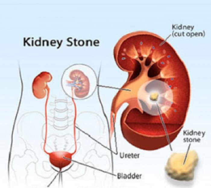 These are the natural home remedies to help flush out kidney stones