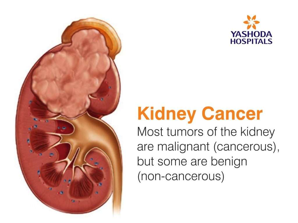 Tumors in Kidney