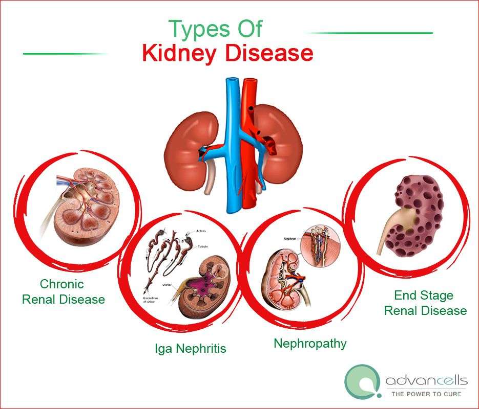 Types Of Kidney Disease. Chronic Renal Disease, Iga ...