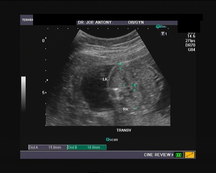 Ultrasound and Color Doppler videos: Hyperechoic fetal kidneys