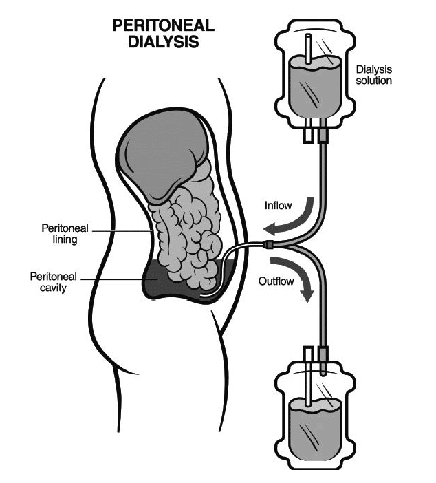 do-you-need-dialysis-with-stage-4-kidney-disease-healthykidneyclub