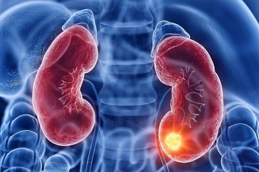 Understanding Kidney Cancer: Its Signs, Symptoms &  Line of Treatment ...