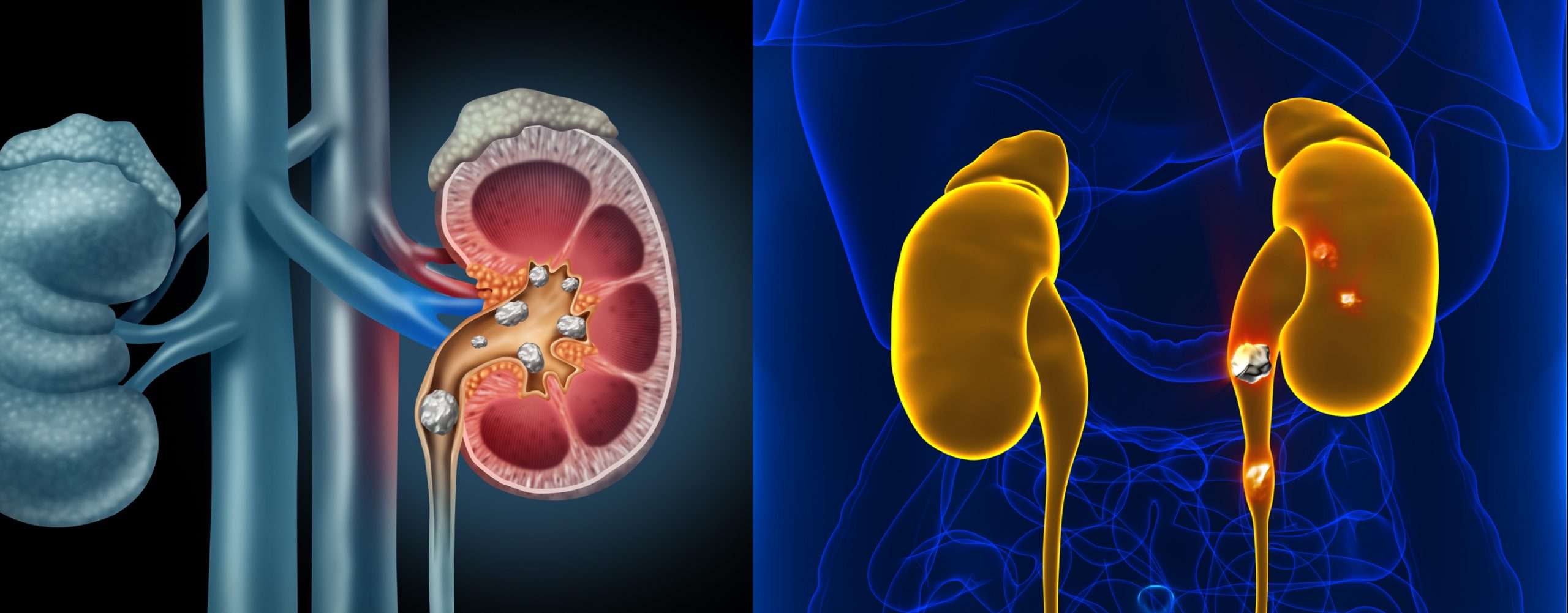 Understanding Kidney Stone