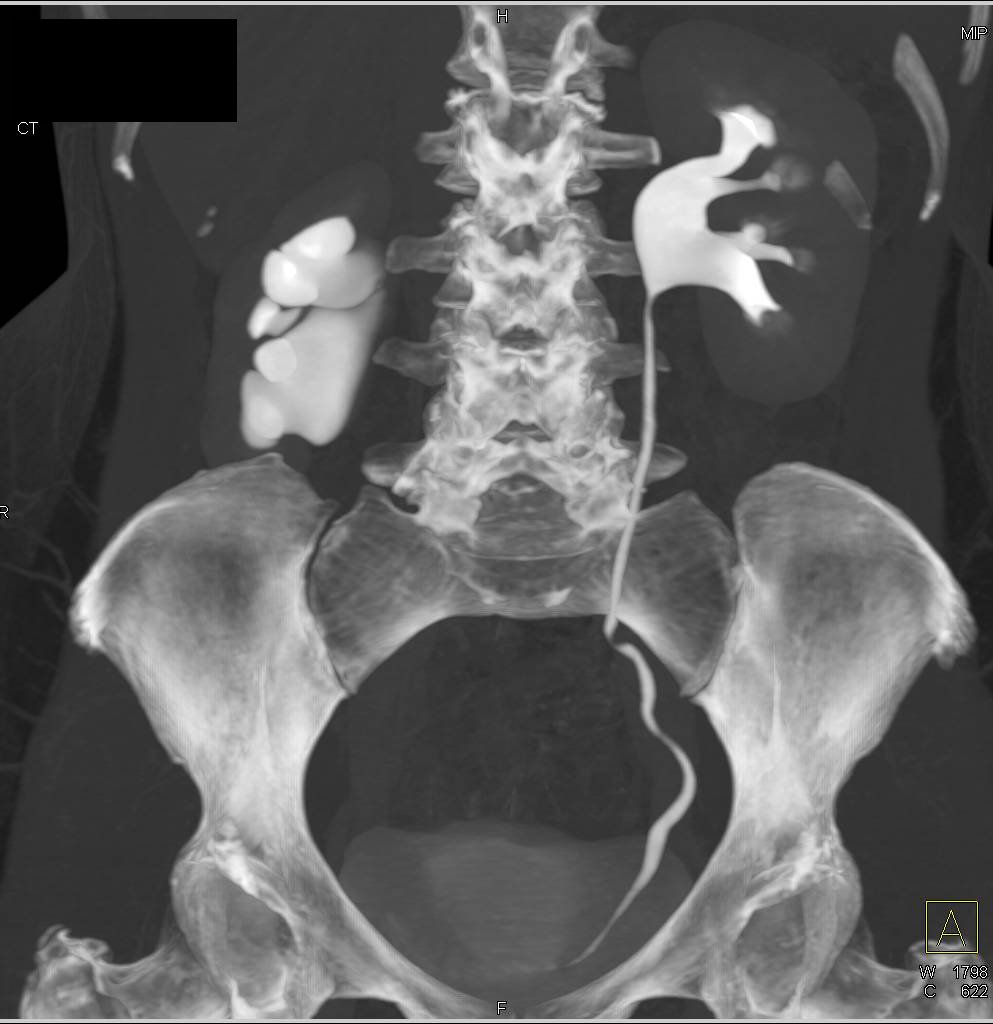 Ureteropelvic Junction (UPJ) Obstruction of the Right ...