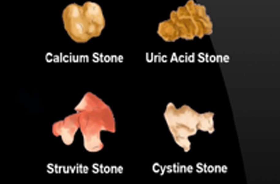 Uric Acid Kidney Stones