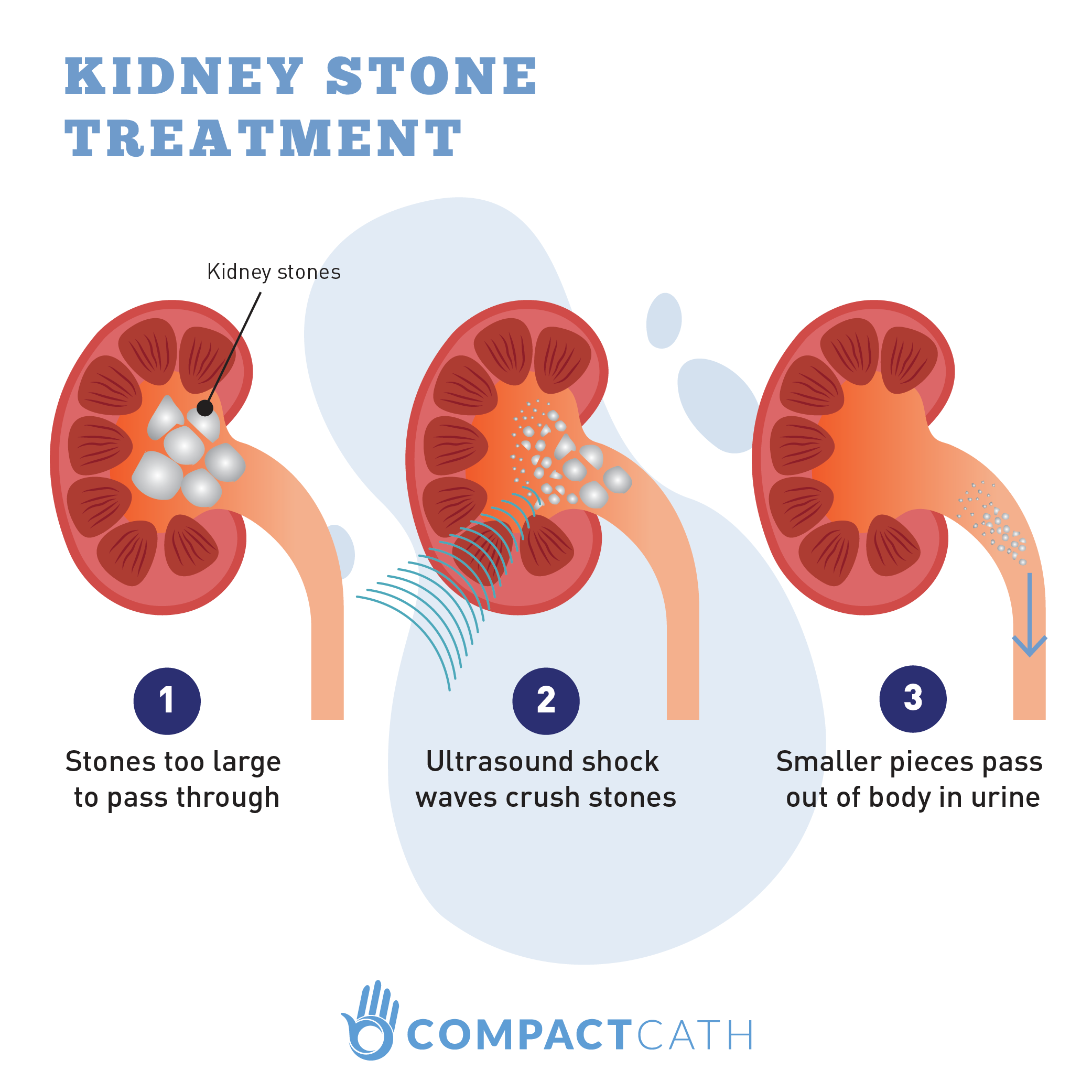 Urinary Incontinence_kidney stone treatment