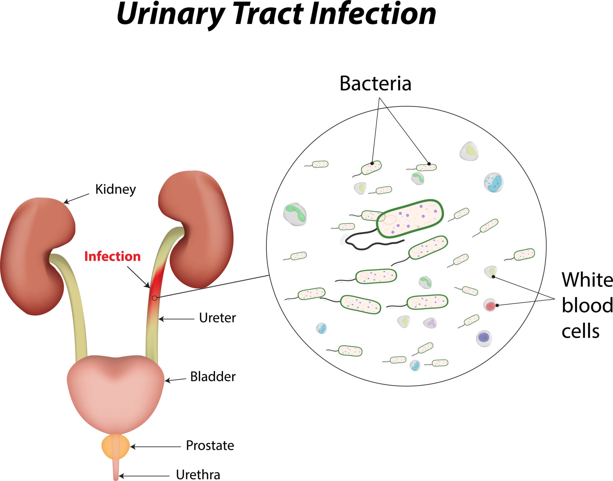 Urinary Tract Infection & Doctor Chattanooga, TN