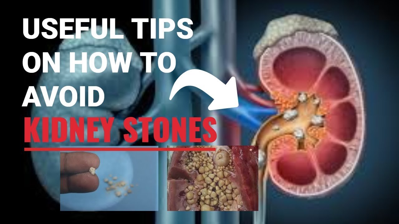 Useful Tips On How To Avoid Kidney Stones.