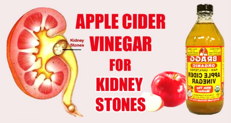 Very Easy Ways to Use Apple Cider Vinegar for Kidney Stones!