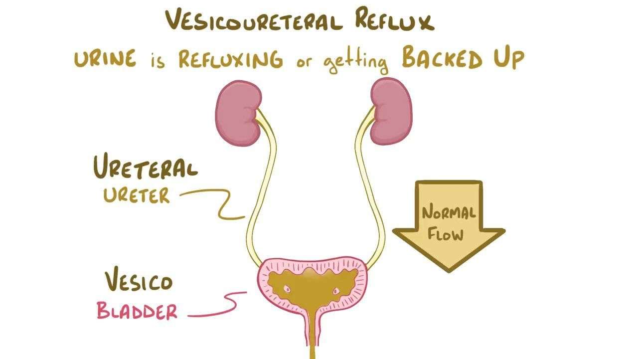 Vesicoureteral Reflux Horseshoe Kidney