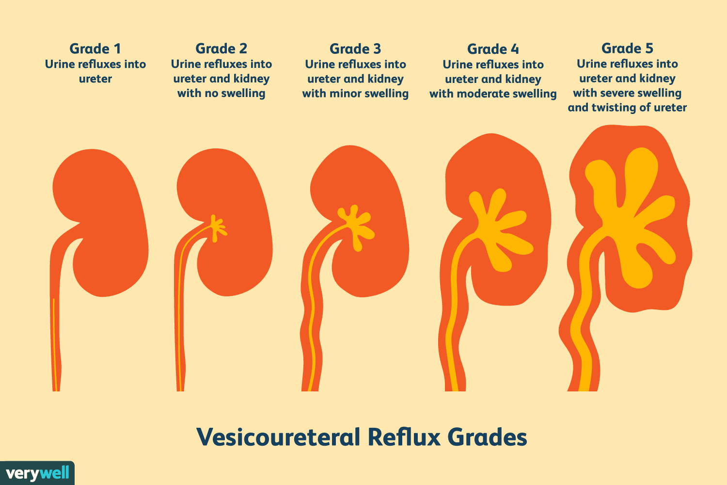 Vesicoureteral Reflux: Symptoms, Causes, and Treatment