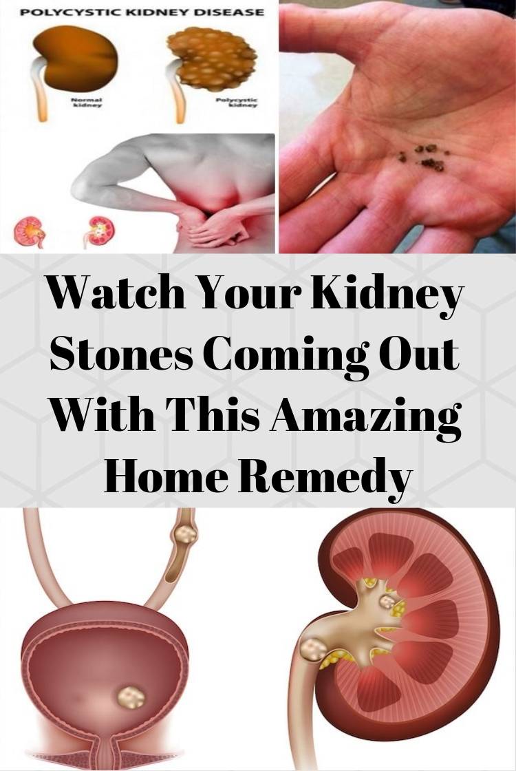 Watch Your Kidney Stones Coming Out With This Amazing Home ...