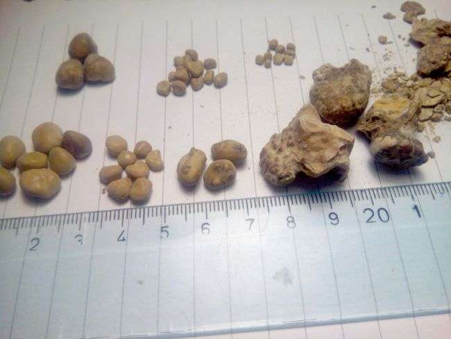 Ways You Can Help Prevent And Treat Kidney Stones