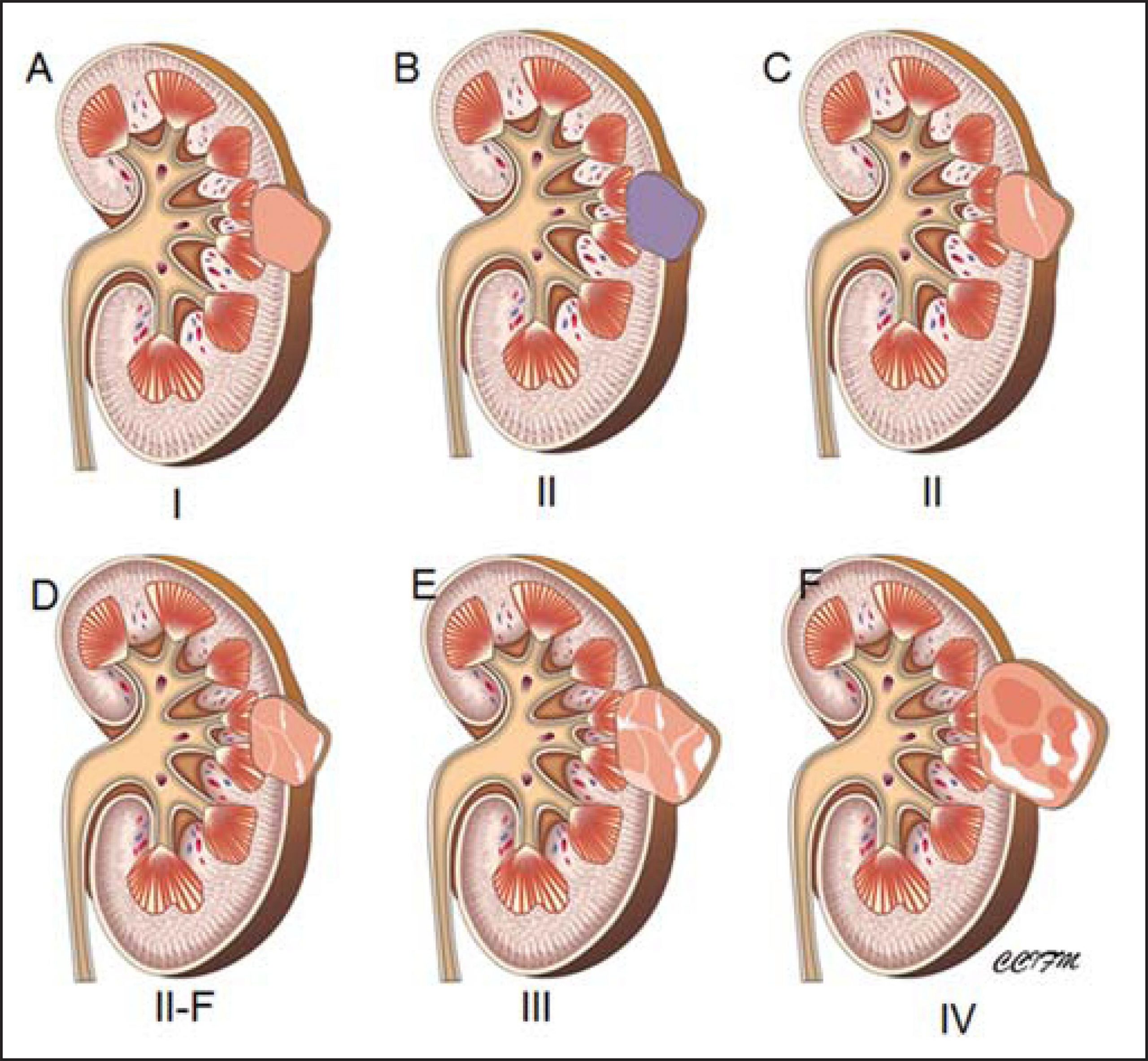 What Are Kidney Cysts? Kidney Cysts Symptoms, Causes, and ...