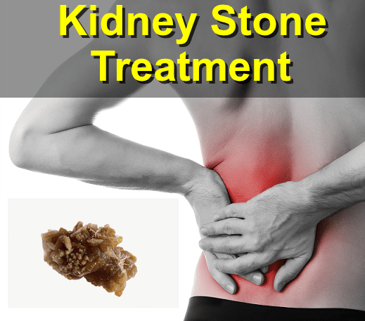 What are some signs, symptoms, possible treatments of kidney stones and ...
