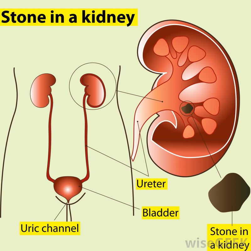 What are the Best Kidney Stone Medicines? (with pictures)
