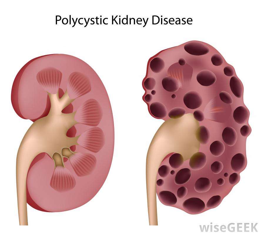 What are the Different Types of Kidney Mass? (with pictures)