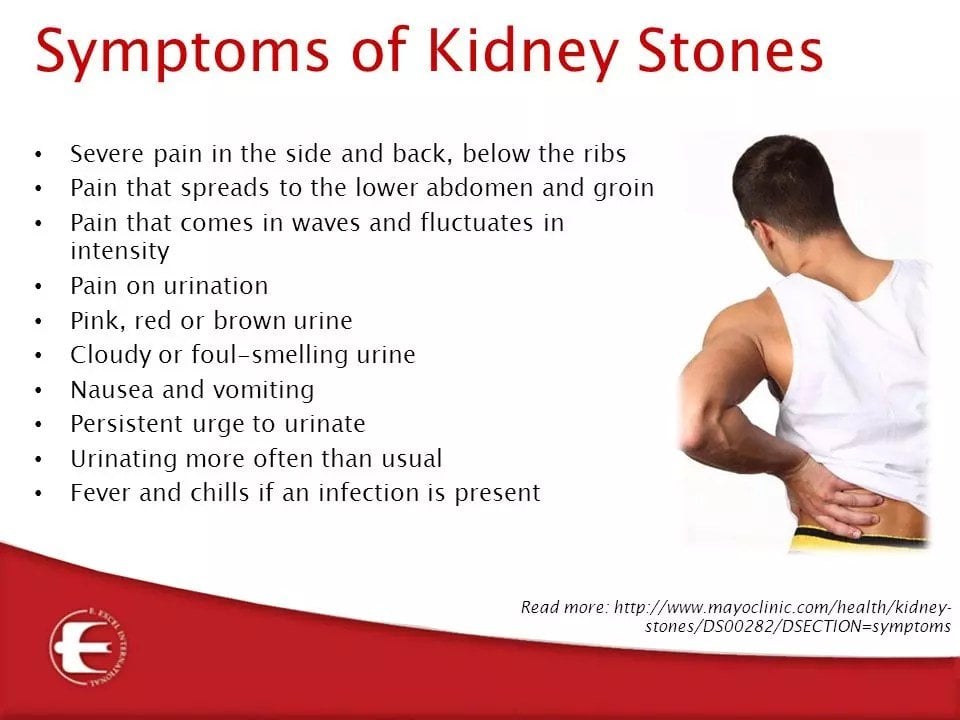 What are the symptoms of kidney stones?