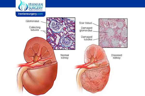 What causes chronic kidney disease (CKD)