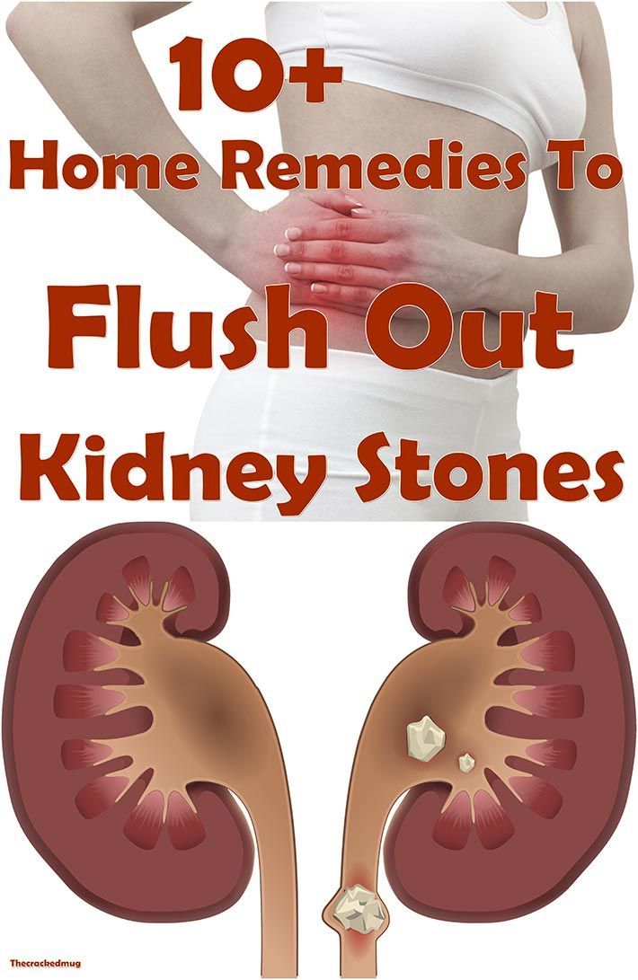 What Do Kidney Stones Feel Like In Females