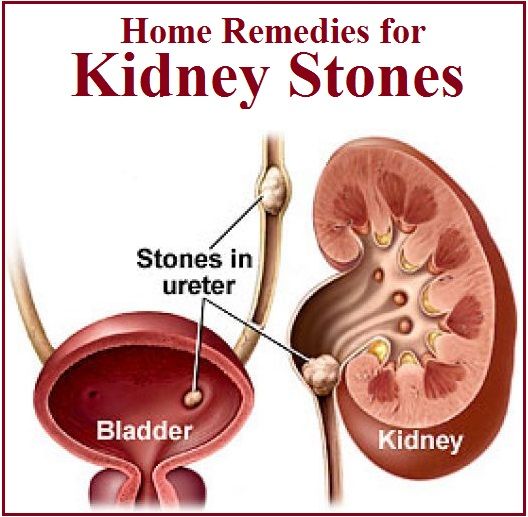 What Do Kidney Stones Feel Like In Woman