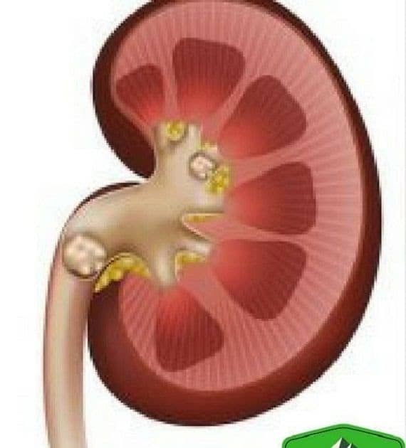 What Do Kidney Stones Feel Like