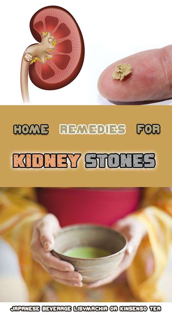 What Do You Kidney Stones Feel Like