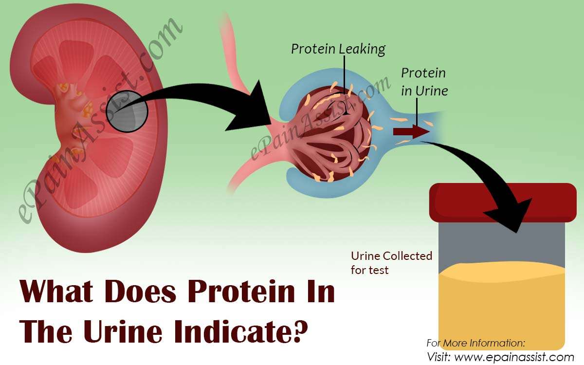 Kidney Stones Cause High Protein In Urine at Brad Hernandez blog