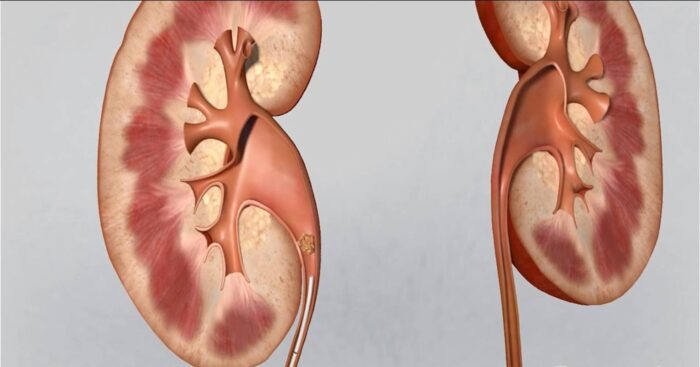 What Happens When Kidneys Fail Causes Signs &  Treatment