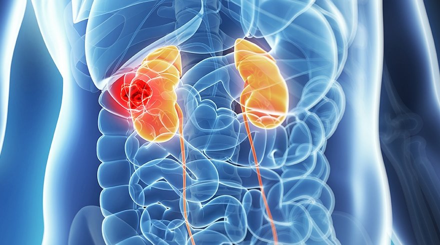 What is kidney cancer? What are the symptoms? How is it ...