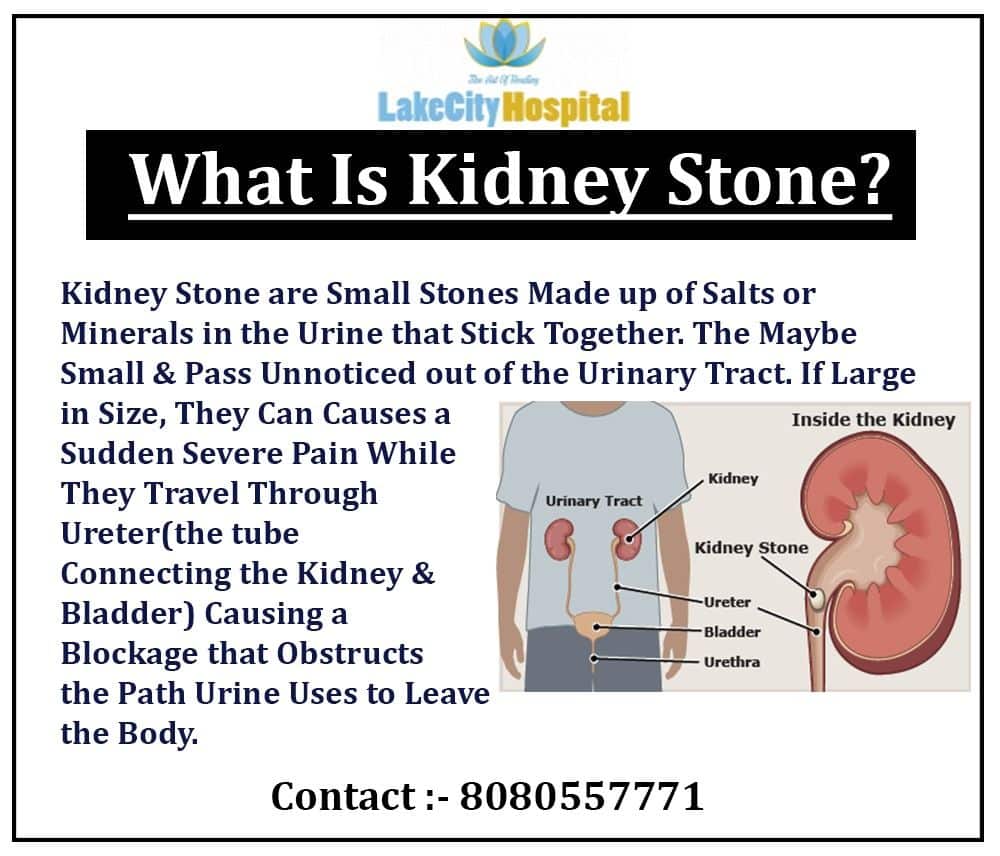 WHAT IS KIDNEY STONE For information contact: 8080557771 #urologist # ...