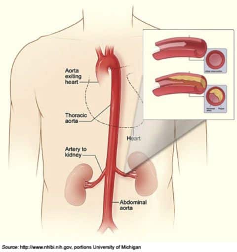 What is the cause of pressure in a human kidney?