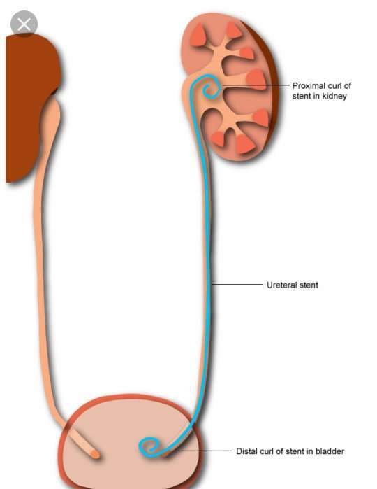 What is the purpose of a stent for kidney stones?