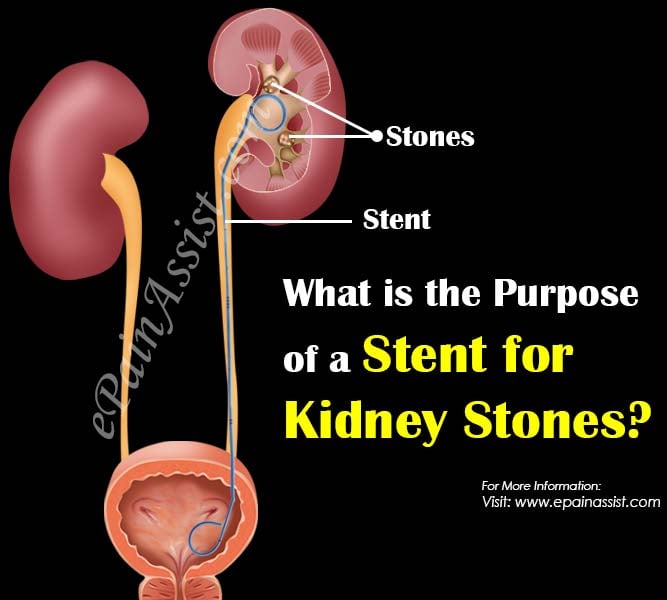What is the Purpose of a Stent for Kidney Stones?