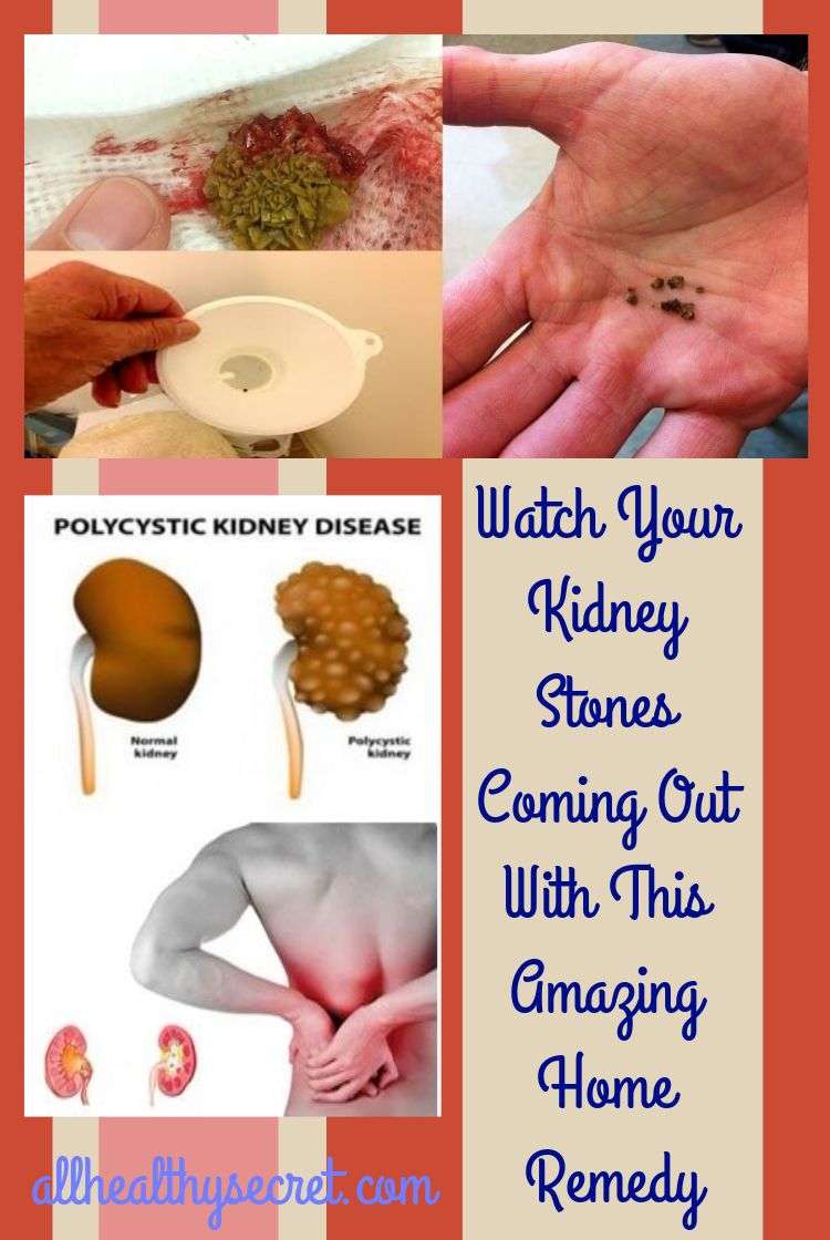 What Kidney Stones Come From