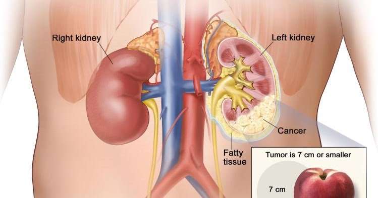 Where Does Kidney Cancer Spread To First