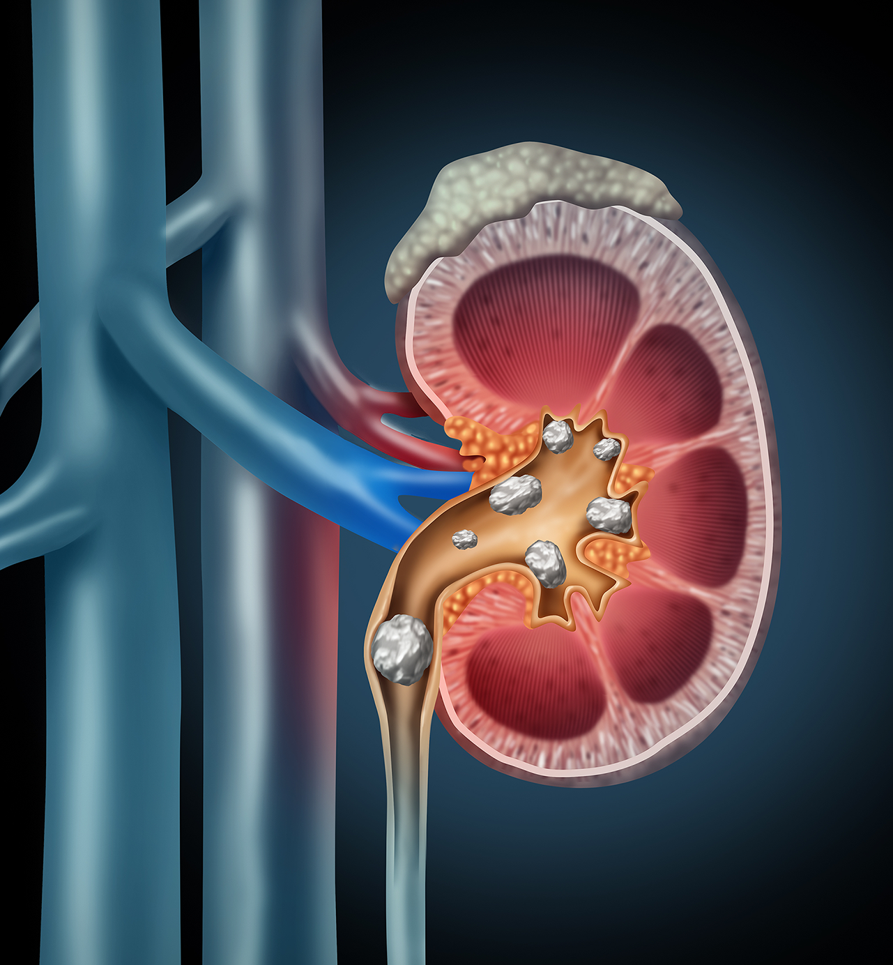 Which Kidney Stone Treatment Method is Right for Me ...