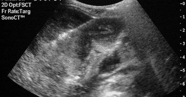 White Spots On Kidney Ultrasound