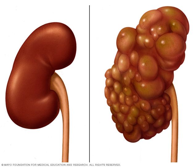 Who Deals With Kidney Cysts