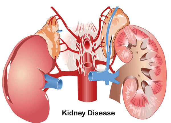WHY KIDNEY FAILS ? Some Common Causes